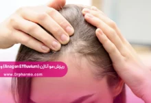 ریزش مو آناژن چیست