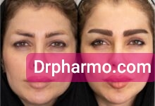 دکتر فارمو کاشت ابرو